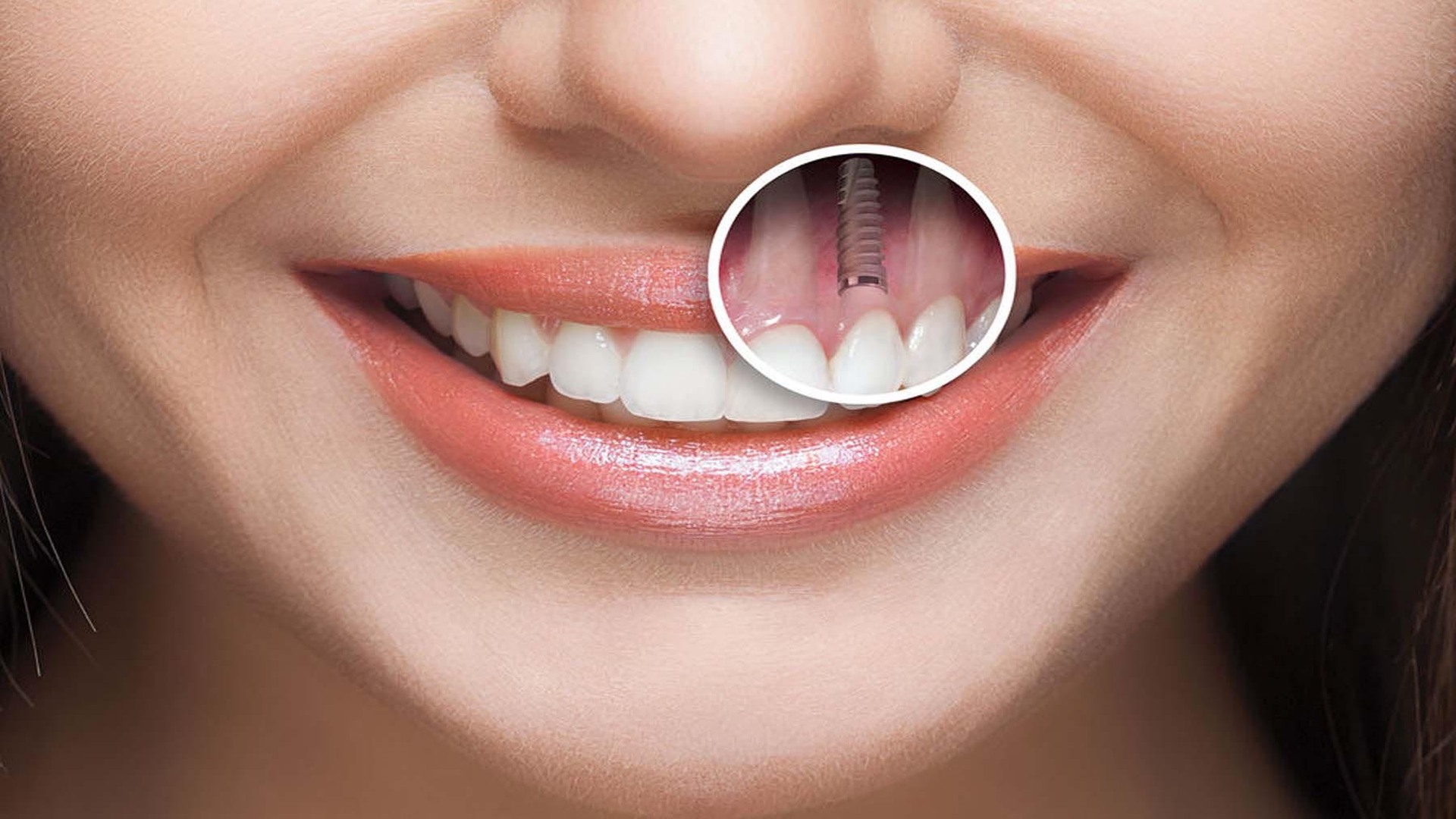 Tooth Implant Treatments